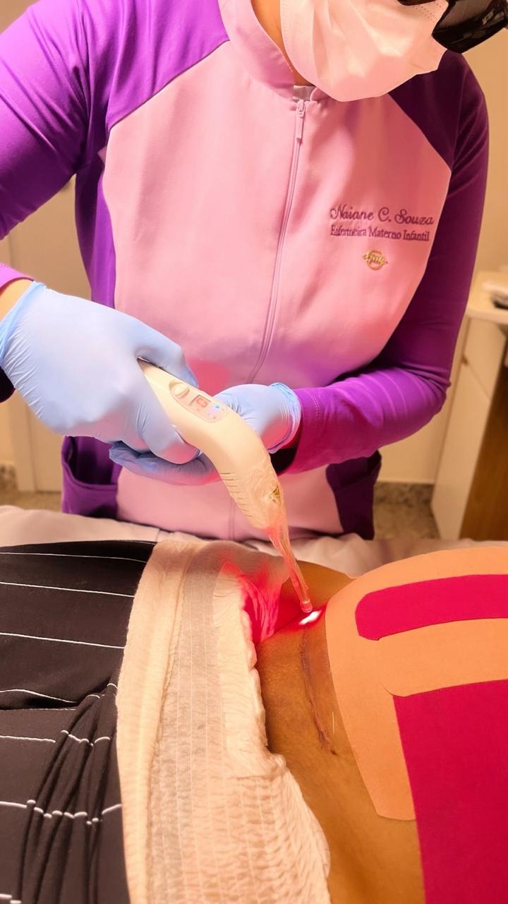 Aplicação de laserterapia em cicatriz cirúrgica
