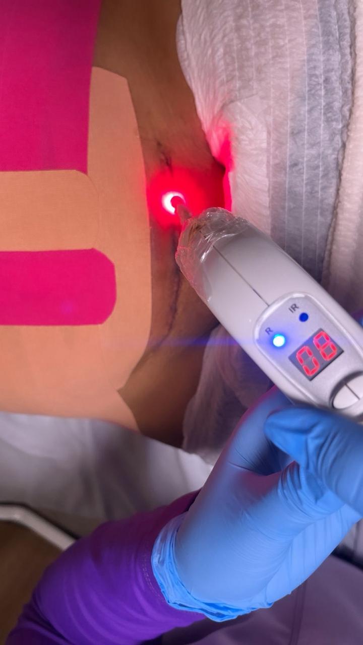 Laserterapia em cicatriz cirúrgica