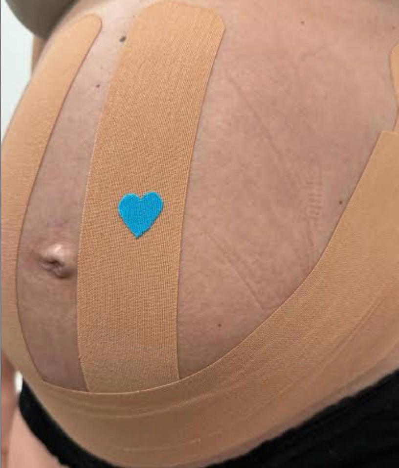 Aplicação de taping em barriga de gestante
